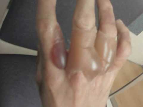how to treat 2nd degree burns on fingers