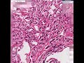 Histopathology Lung--Bronchial carcinoid Histopathology Lung--Bronchial carcinoid