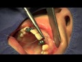 Zahn-OP Dr. Blum - Keystone Implantat