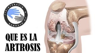 Artritis y Artrosis - ¿Qué es la artrosis y cómo se produce?. Artritis y Artrosis - ¿Qué es la artrosis y cómo se produce?.