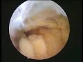 elbow arthroscopy osteophyte removal ??????????????? ?????? ?????????