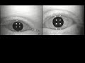 Tulsa Nystagmus 1