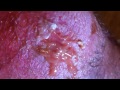 Lancing mrsa 5