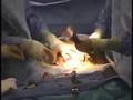 Alex's cesarean section-part 1