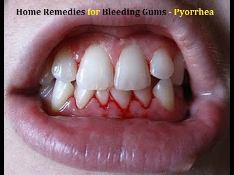 how to cure pyorrhea naturally