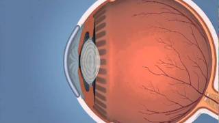 Glaucoma