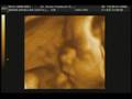 videos de USG 4D  EMBARASO DE 32 SEMANAS Dr. Patatuchi
