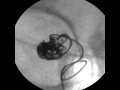 Identification Of Cranial Aneurysms With A Fluoroscope - Part 1 Identification Of Cranial Aneurysms With A Fluoroscope - Part 1