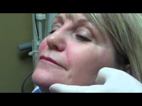 how to administer juvederm