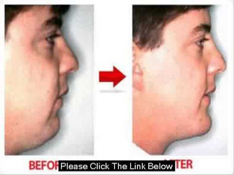 how to reduce cheeks