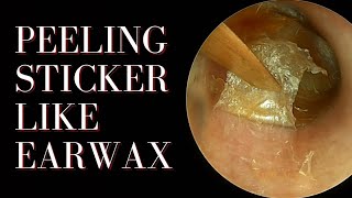 Peeling Sticker-Like Earwax