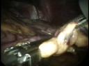 Dr. Joya Gastric Sleeve Surgery