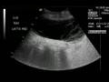 Spontraneous bacterial peritonitis