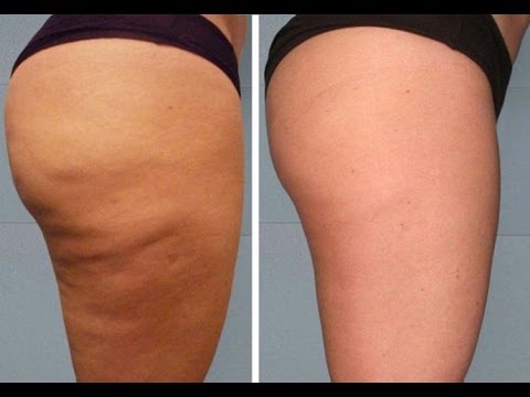 how to remove cellulite