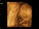 Dzaky Mom 6 Month Pregnant   4 Dimension UltraSonoGraphy 3 Ultrasonography