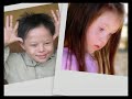 Down syndrome:&nbsp;Sindrome de Down 1