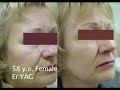 Erbium Laser Resurfacing Before and After Phots Erbium Laser Resurfacing Before and After Phots