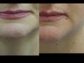 videos de Erbium Laser Resurfacing Before and After Phots