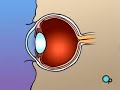 PreOp® Patient Education Opthamology: PRK Laser Eye Surgery Laser Eye Surgery