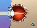 PreOp® Patient Education Opthamology: PRK Laser Eye Surgery