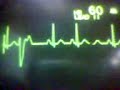 ECG Video: Ectopics - Ventricular, unifocal
