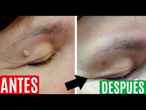how to cure un ojo de pescado