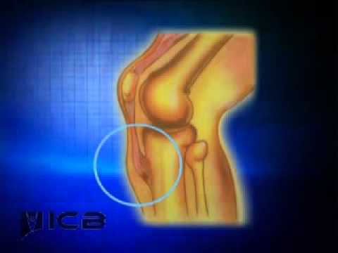 how to treat osgood schlatter