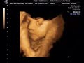 3D / 4D Baby Scan 3D / 4D Baby Scan
