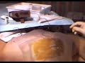 Posterior Sciatic Block Posterior Sciatic Block