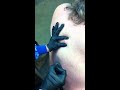 Cyst Popping fun