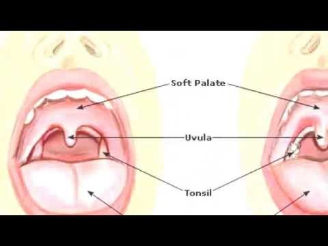 how to cure uvulitis