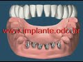 Implantes dentarios
