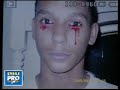 Boy Cries Tears of Blood