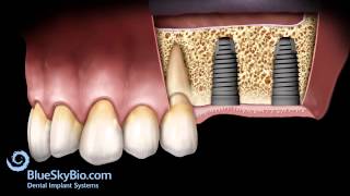 Sinus Lift Lateral