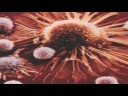 Lung Cancer & Its Symptoms