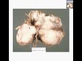 Histopathology--Brain Meningioma
