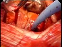 beating heart surgery Top end