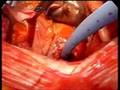 beating heart surgery Top end