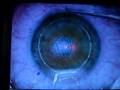 LASIK cerrahisi LASIK cerrahisi