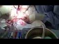 Bypass Surgery