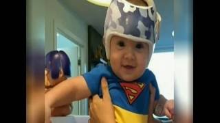 Tratamento com 'capacete' pode curar bebês que nascem com deformidade no crânio - Jornal da