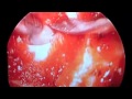Rathke Cleft Cyst in the Sella