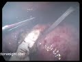 Swedish band removal for acute slippage