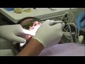 Indirect Bonding Initial Tie-In Part 3 Indirect Bonding Initial Tie-In Part 3