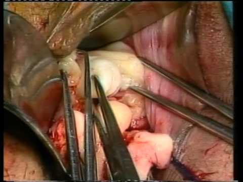 utero miomatoso}