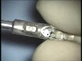 STAAR Visian ICL front coaxial forceps loading