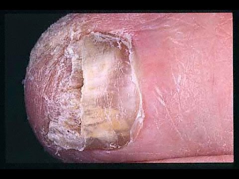 how to get rid of hand fungus