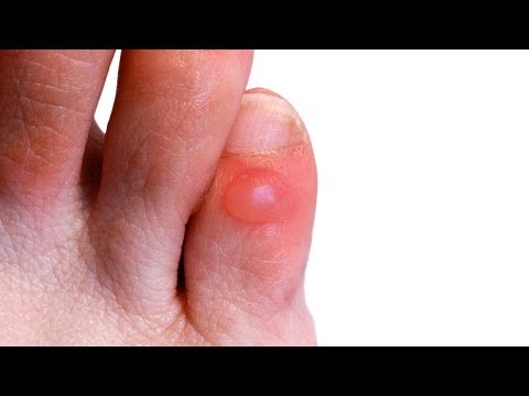 how to treat a blister on a foot