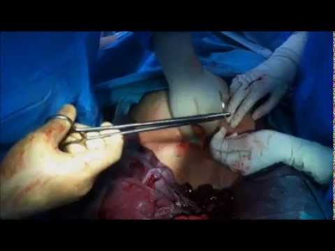 how to take care of a c section incision