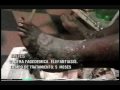 Elefantiasis con ulcera / Elephantiasis with ulcer Elefantiasis con ulcera / Elephantiasis with ulcer